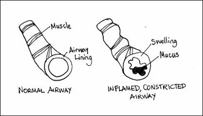 Horse affected by COPD or severe equine asthma